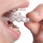 Invisalign Clear Braces, Comox Dentist 