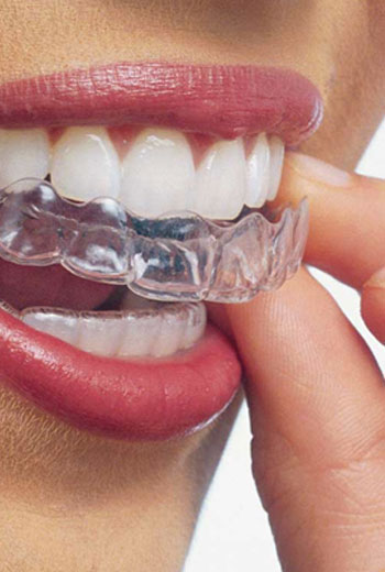 Orthodontics, Braces & Invisalign, Comox Dentist